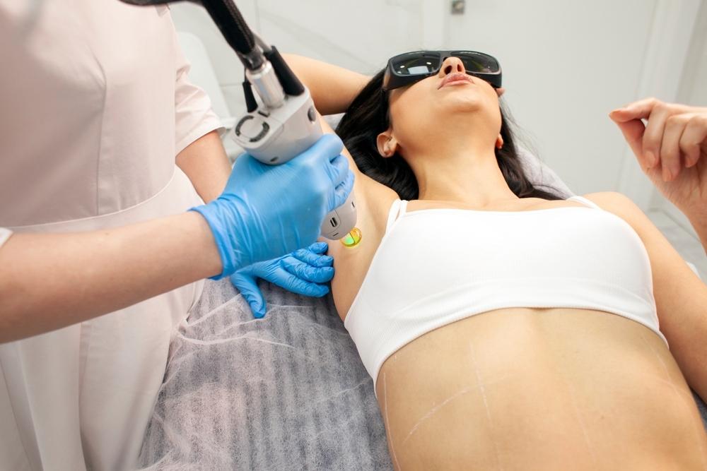 laser aisselles laser aisselles