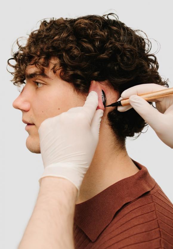 chirurgie d'otoplastie