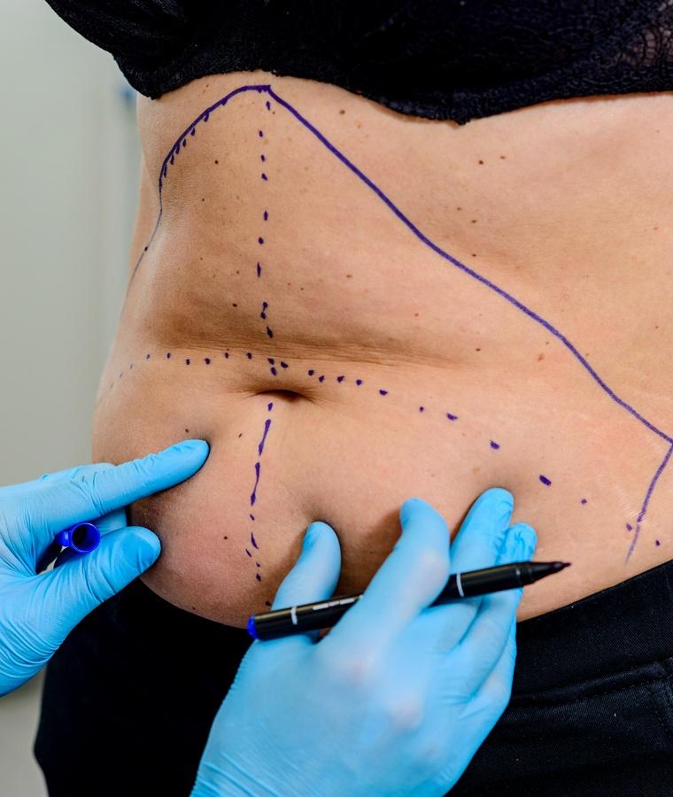 Liposculpture Uccle 