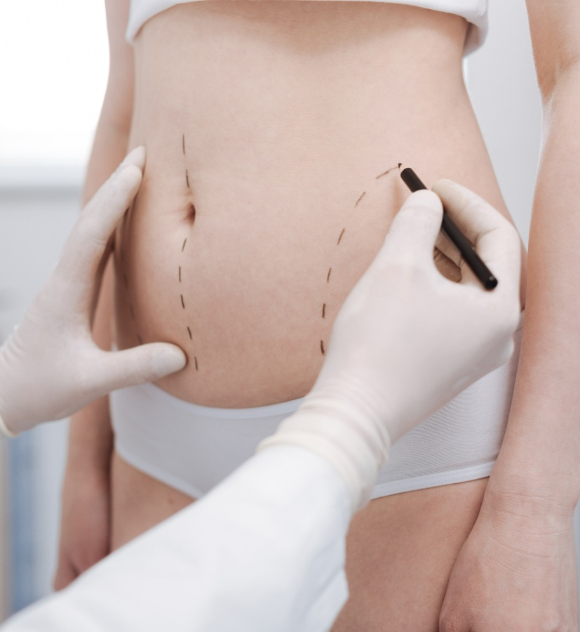 Liposculpture Ixelles  