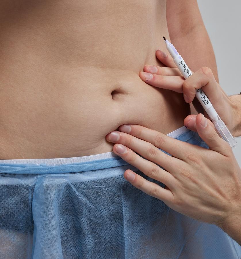 technique Abdominoplastie