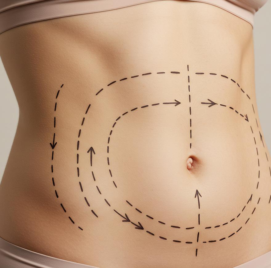 Abdominoplastie Ixelles 
