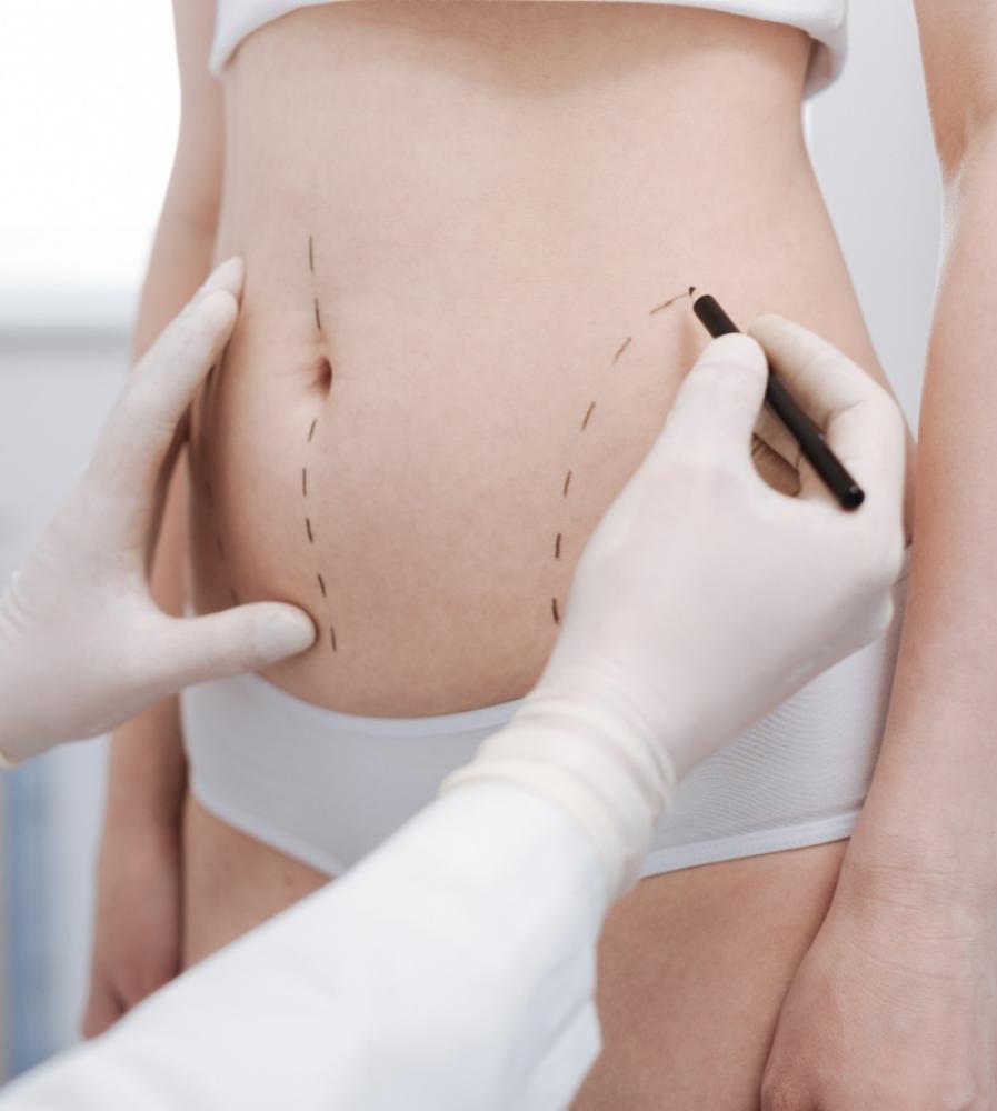 Liposculpture Ixelles  